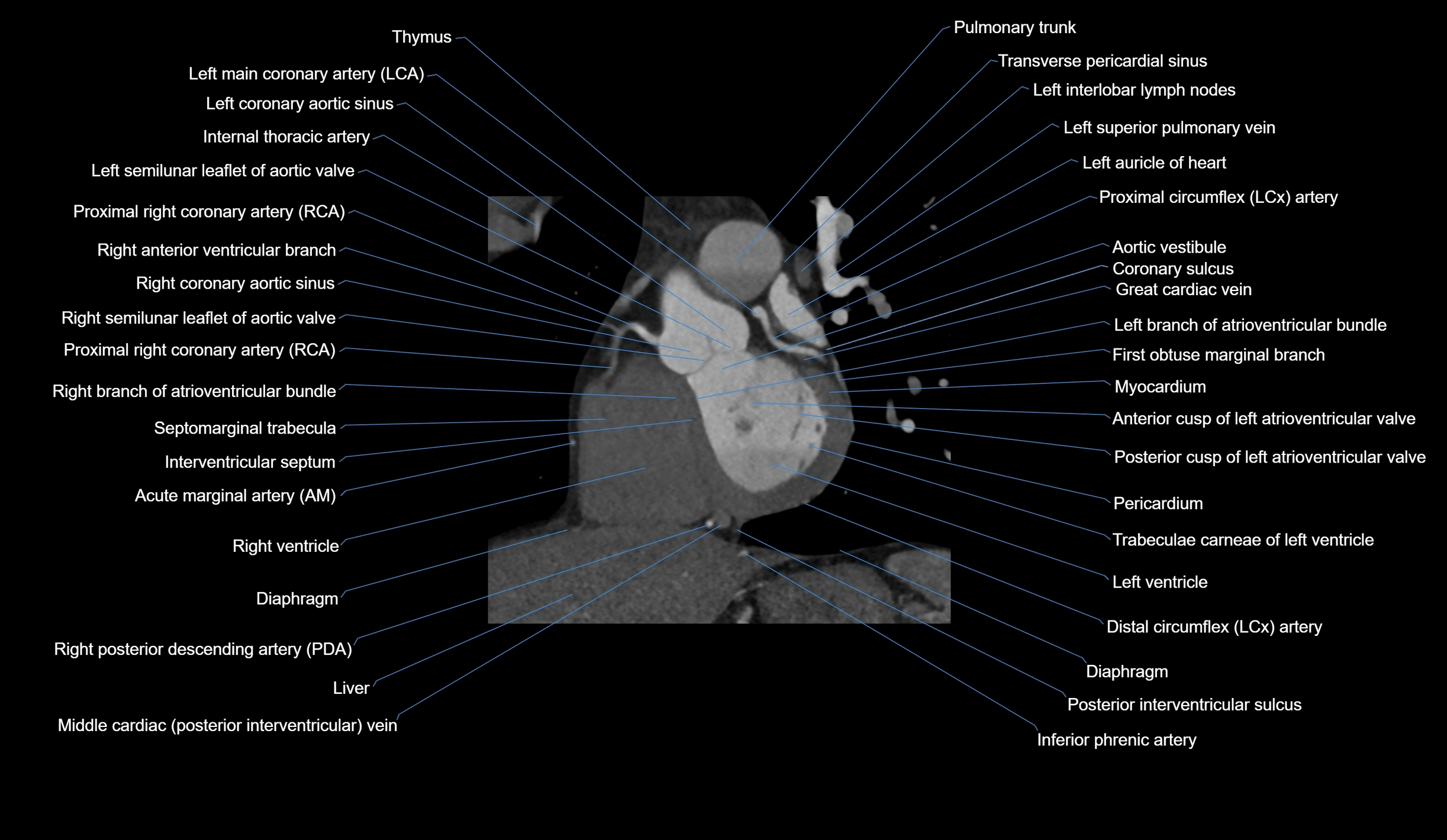 CT heart (coronary angiogram) short axis view  cross sectional anatomy labelled radiology image-00023.webp
